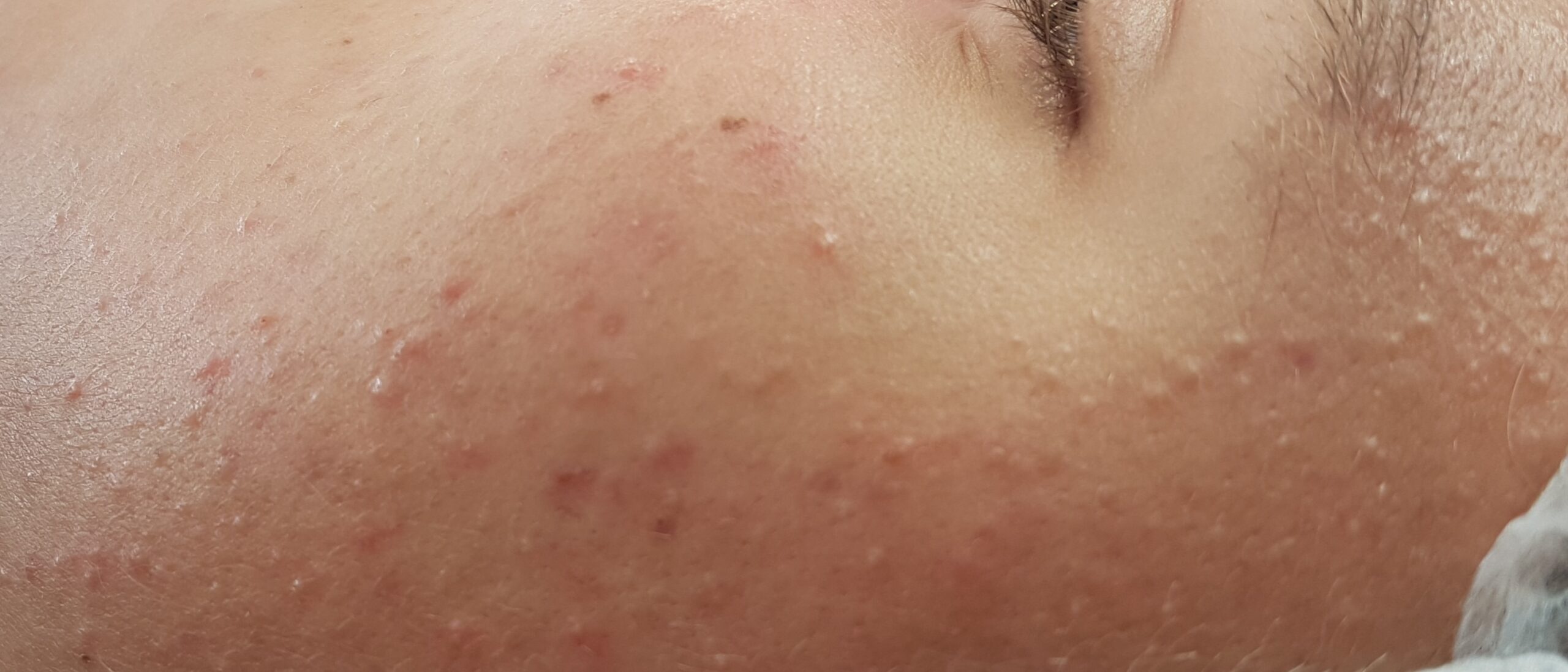 Ambient In zoomen Arabisch Wat helpt tegen een vette huid? - Cosmederma